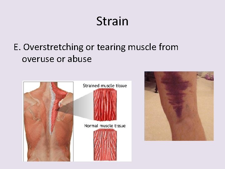 Strain E. Overstretching or tearing muscle from overuse or abuse 