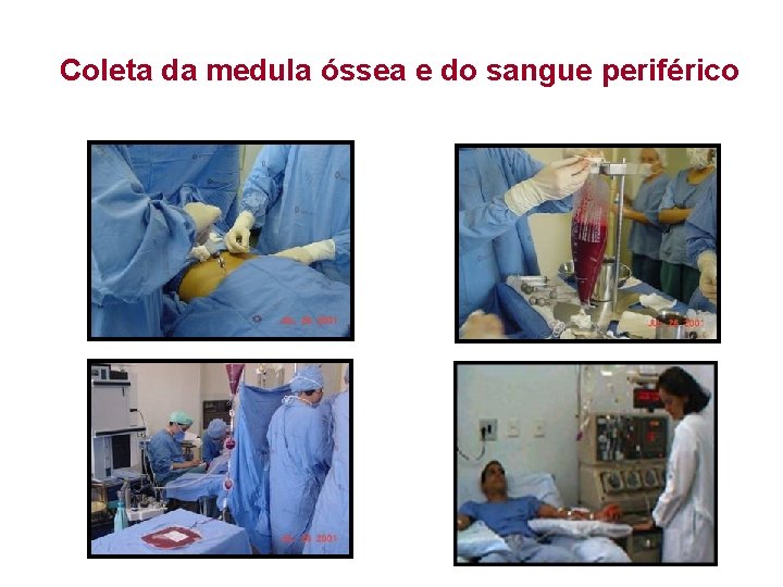 Coleta da medula óssea e do sangue periférico 