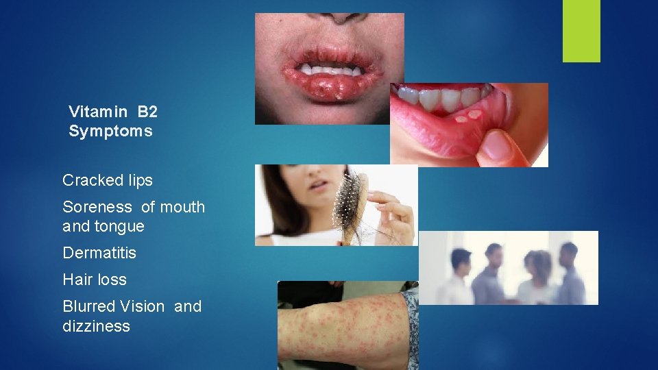 Vitamin B 2 Symptoms Cracked lips Soreness of mouth and tongue Dermatitis Hair loss