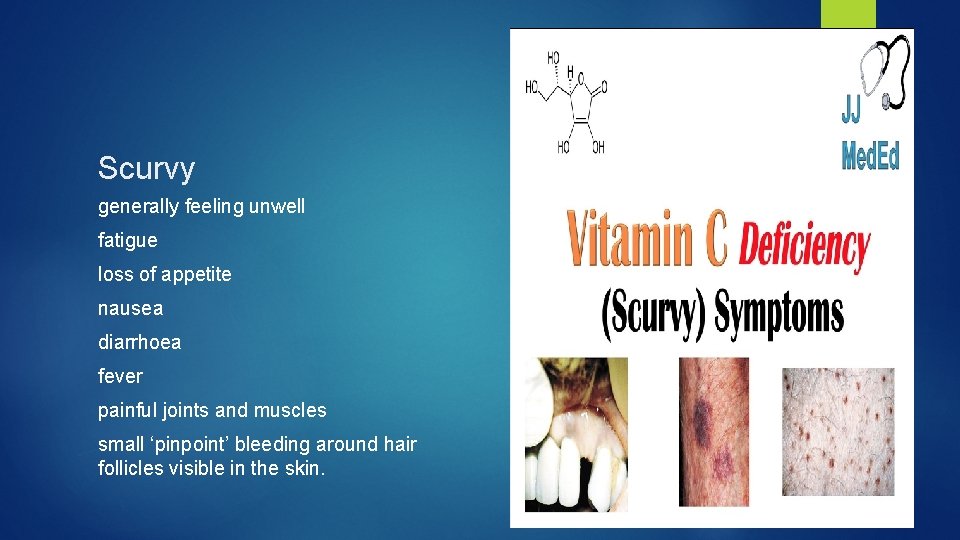 Scurvy generally feeling unwell fatigue loss of appetite nausea diarrhoea fever painful joints and