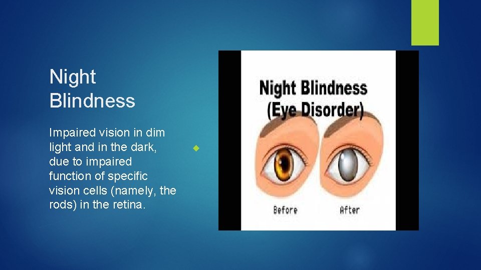 Night Blindness Impaired vision in dim light and in the dark, due to impaired