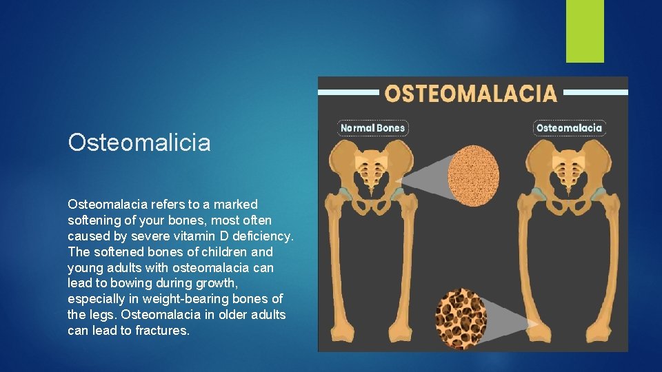 Osteomalicia Osteomalacia refers to a marked softening of your bones, most often caused by