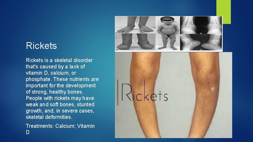 Rickets is a skeletal disorder that's caused by a lack of vitamin D, calcium,