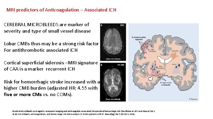 MRI predictors of Anticoagulation – Associated ICH CEREBRAL MICROBLEEDS are marker of severity and