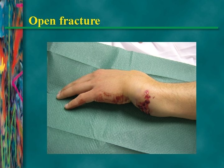 Open fracture 