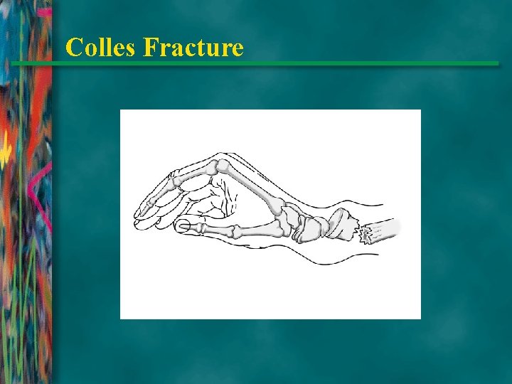 Colles Fracture 