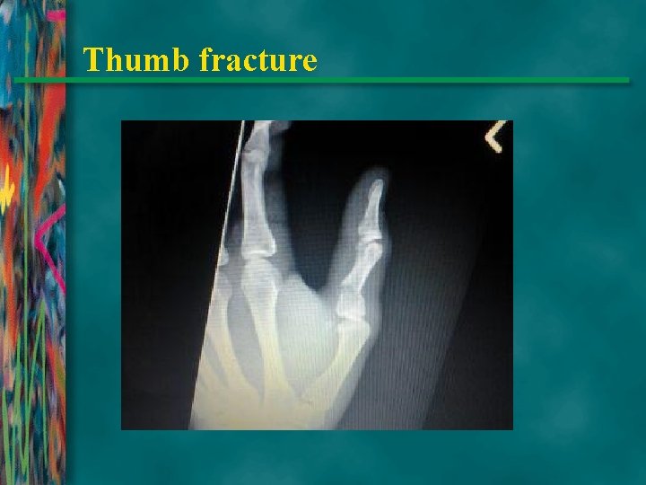Thumb fracture 