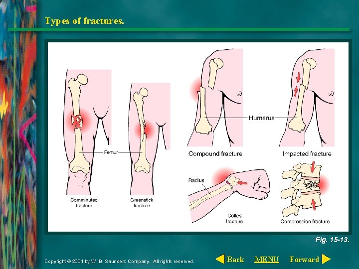 Types of fractures. Fig. 15 -13. Copyright © 2001 by W. B. Saunders Company.