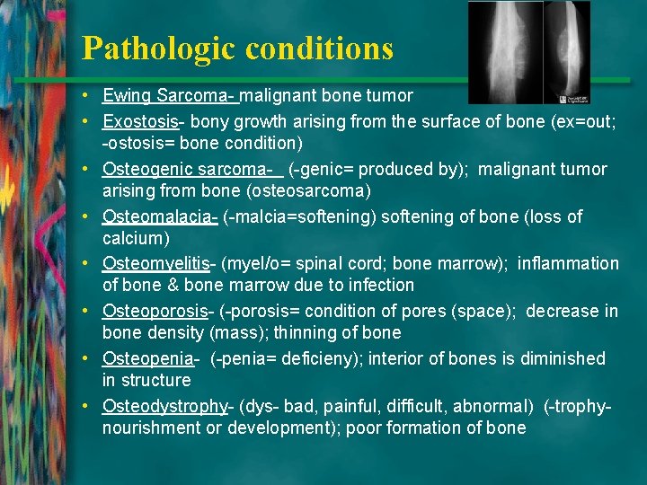 Pathologic conditions • Ewing Sarcoma- malignant bone tumor • Exostosis- bony growth arising from