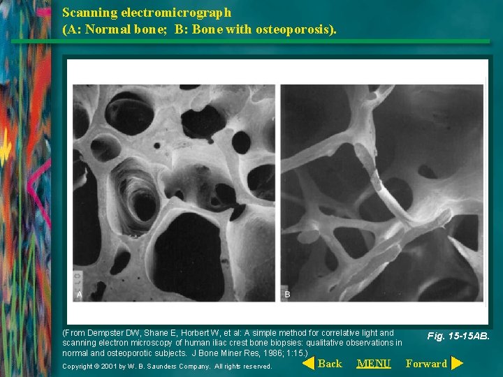 Scanning electromicrograph (A: Normal bone; B: Bone with osteoporosis). (From Dempster DW, Shane E,