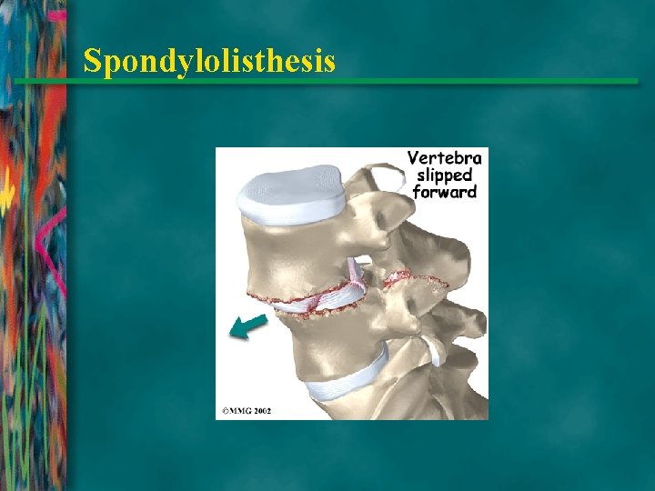 Spondylolisthesis 