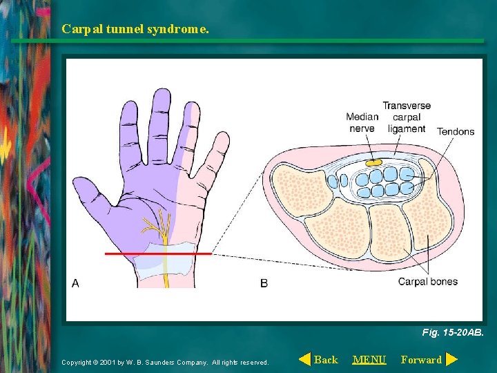 Carpal tunnel syndrome. Fig. 15 -20 AB. Copyright © 2001 by W. B. Saunders