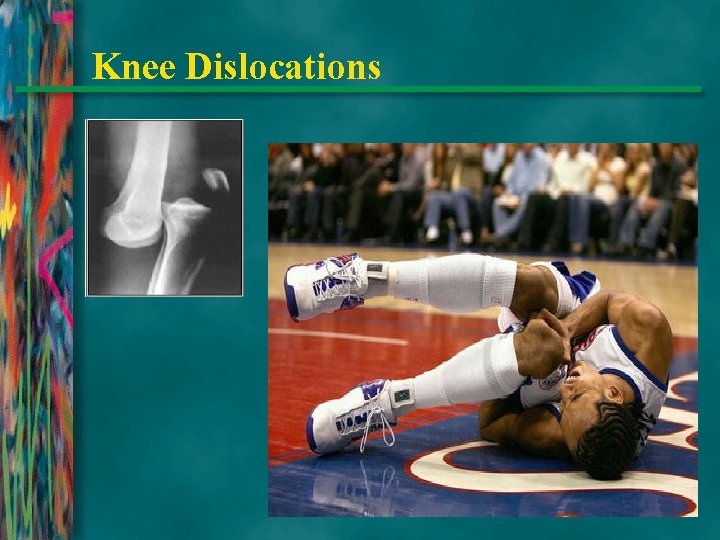 Knee Dislocations 