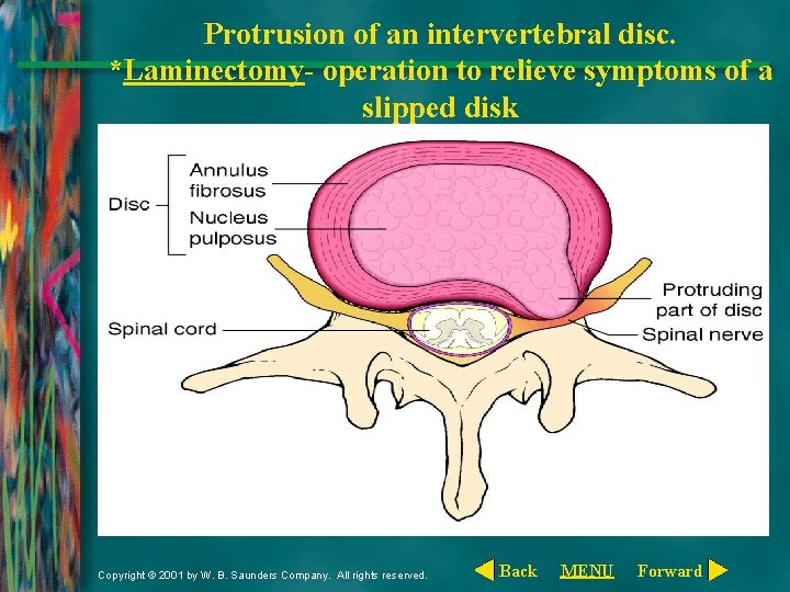 Protrusion of an intervertebral disc. *Laminectomy- operation to relieve symptoms of a slipped disk