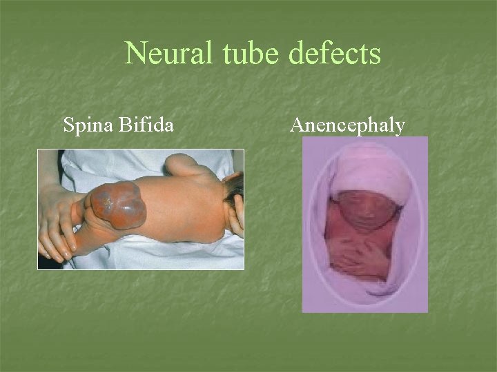 Neural tube defects Spina Bifida Anencephaly 