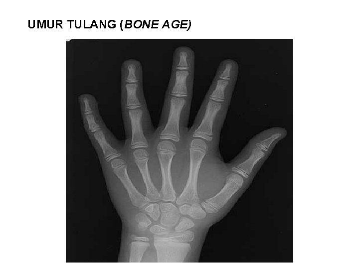 UMUR TULANG (BONE AGE) 