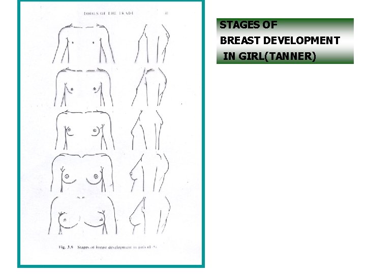 STAGES OF BREAST DEVELOPMENT IN GIRL(TANNER) 