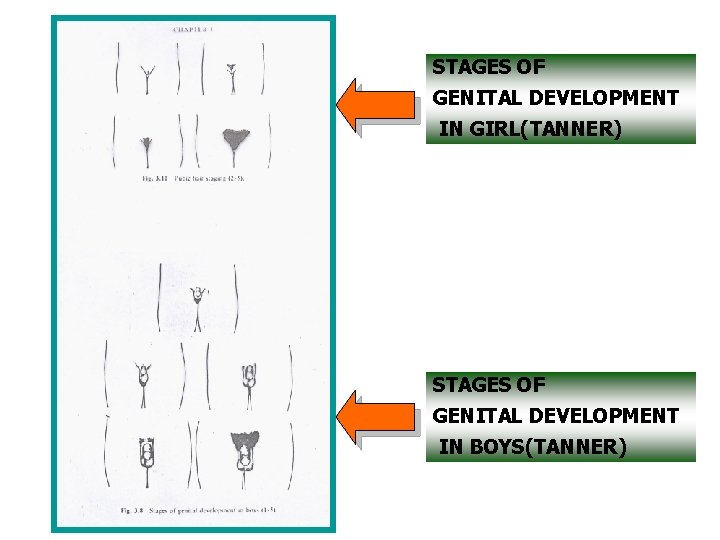 STAGES OF GENITAL DEVELOPMENT IN GIRL(TANNER) STAGES OF GENITAL DEVELOPMENT IN BOYS(TANNER) 