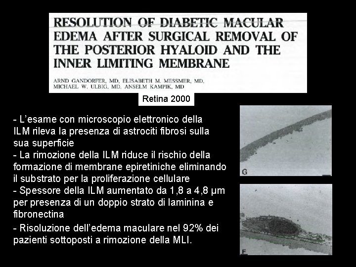 R Retina 2000 - L’esame con microscopio elettronico della ILM rileva la presenza di