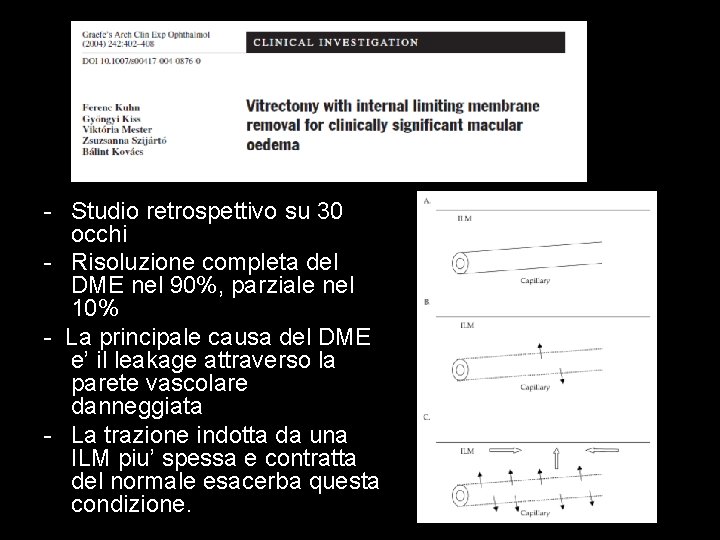 - Studio retrospettivo su 30 occhi - Risoluzione completa del DME nel 90%, parziale