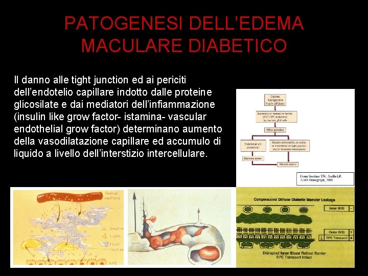 PATOGENESI DELL’EDEMA MACULARE DIABETICO Il danno alle tight junction ed ai periciti dell’endotelio capillare