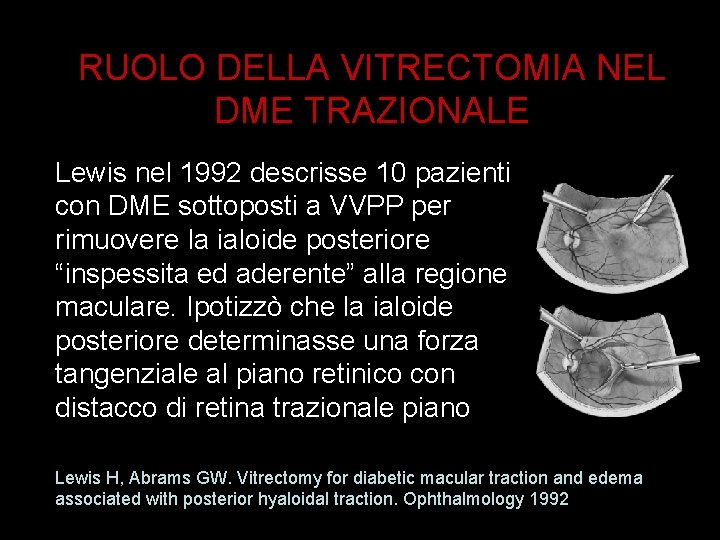 RUOLO DELLA VITRECTOMIA NEL DME TRAZIONALE Lewis nel 1992 descrisse 10 pazienti con DME