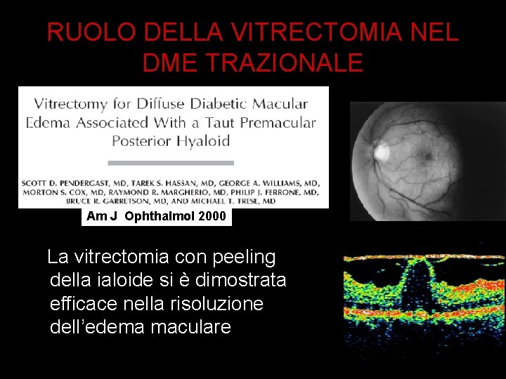 RUOLO DELLA VITRECTOMIA NEL DME TRAZIONALE Am J Ophthalmol 2000 La vitrectomia con peeling