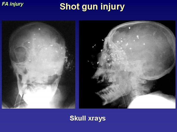 Shot gun injury uraizy FA injury Skull xrays 