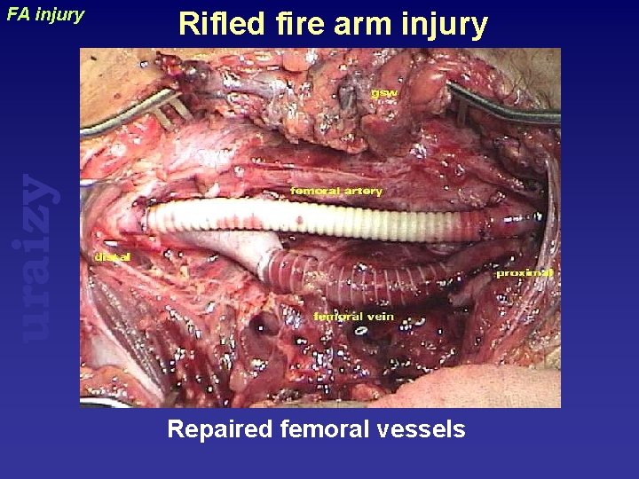 Rifled fire arm injury uraizy FA injury Repaired femoral vessels 