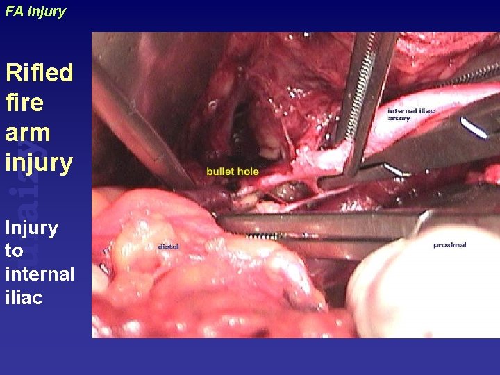 FA injury uraizy Rifled fire arm injury Injury to internal iliac 