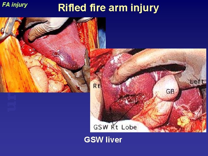 Rifled fire arm injury uraizy FA injury GSW liver 