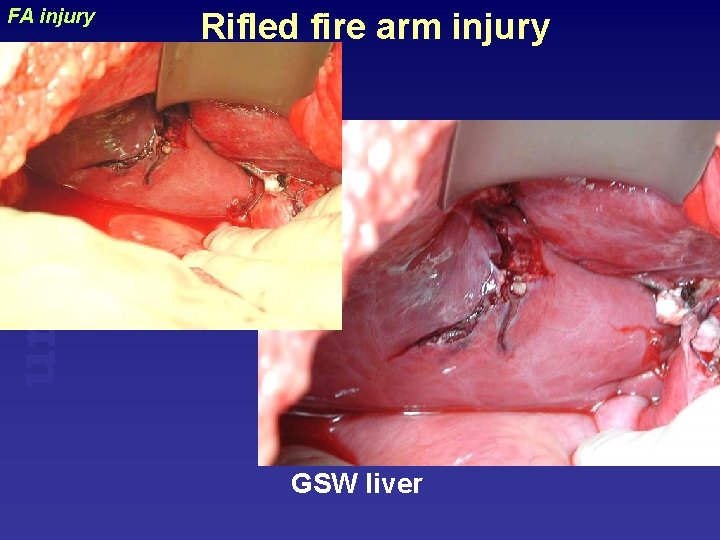 Rifled fire arm injury uraizy FA injury GSW liver 