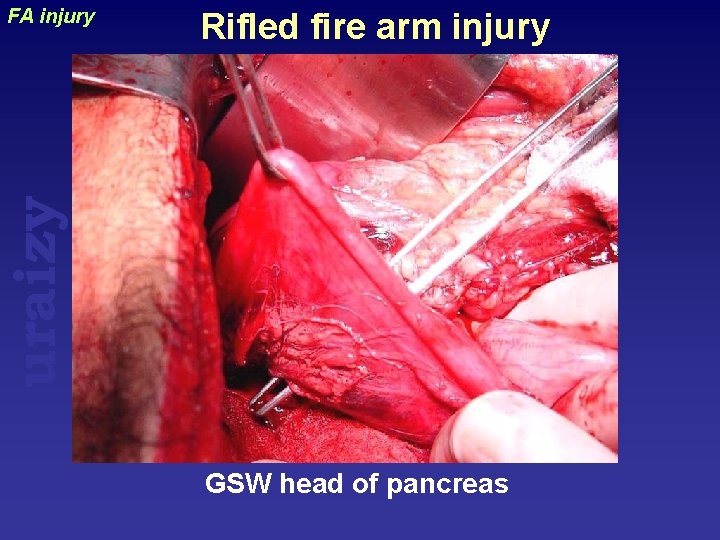 Rifled fire arm injury uraizy FA injury GSW head of pancreas 