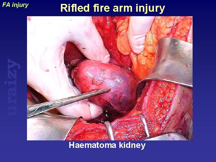 Rifled fire arm injury uraizy FA injury Haematoma kidney 