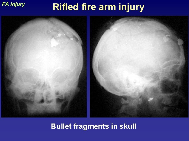 Rifled fire arm injury uraizy FA injury Bullet fragments in skull 