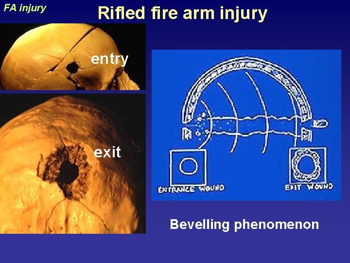 uraizy FA injury Rifled fire arm injury entry exit Bevelling phenomenon 