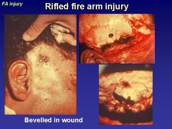 Rifled fire arm injury uraizy FA injury Bevelled in wound 