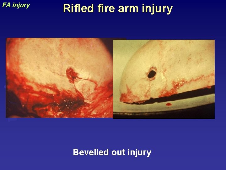 Rifled fire arm injury uraizy FA injury Bevelled out injury 