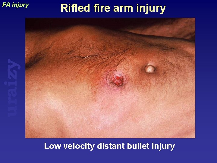 Rifled fire arm injury uraizy FA injury Low velocity distant bullet injury 