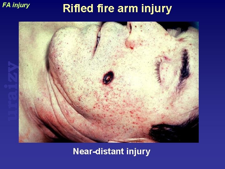 Rifled fire arm injury uraizy FA injury Near-distant injury 