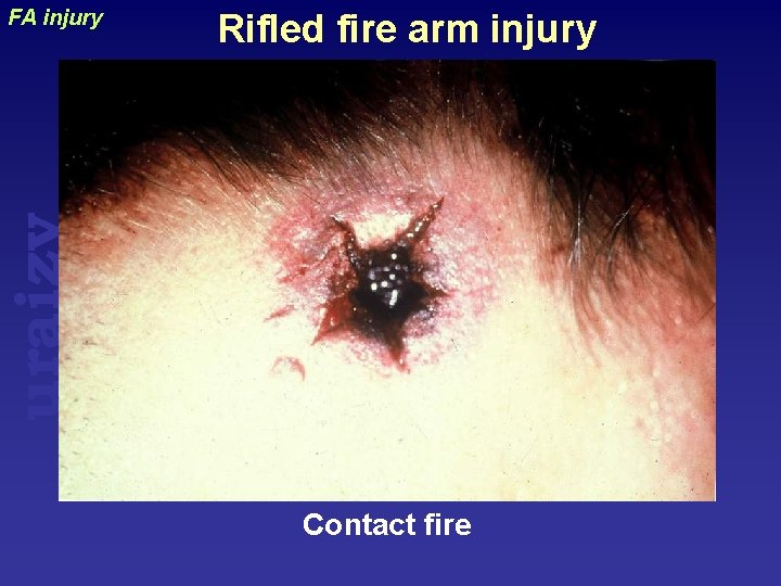 Rifled fire arm injury uraizy FA injury Contact fire 