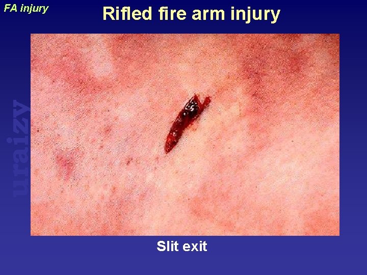 Rifled fire arm injury uraizy FA injury Slit exit 