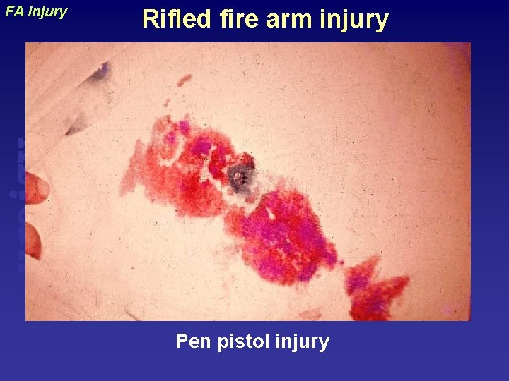 Rifled fire arm injury uraizy FA injury Pen pistol injury 