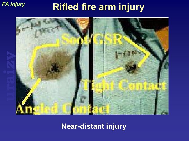 Rifled fire arm injury uraizy FA injury Near-distant injury 