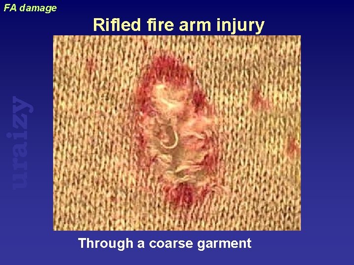 FA damage uraizy Rifled fire arm injury Through a coarse garment 