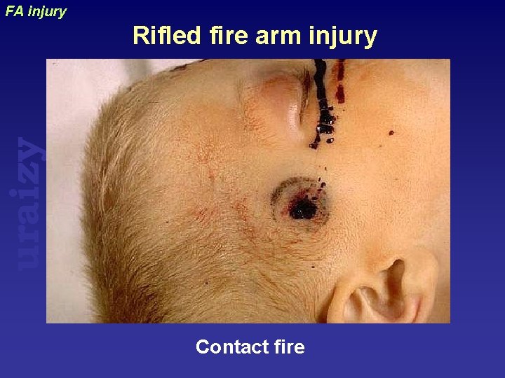 FA injury uraizy Rifled fire arm injury Contact fire 