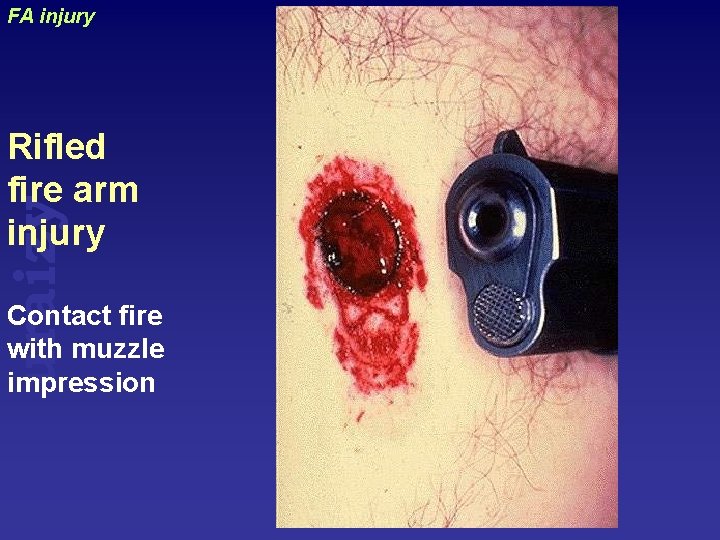 FA injury uraizy Rifled fire arm injury Contact fire with muzzle impression 