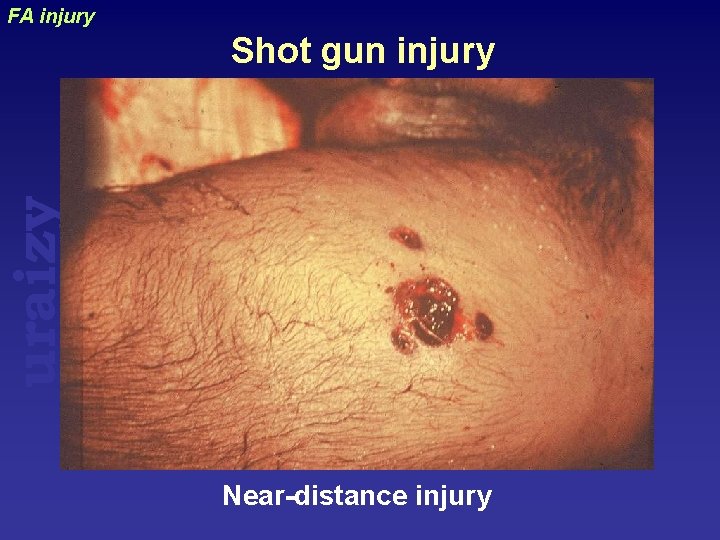 FA injury uraizy Shot gun injury Near-distance injury 