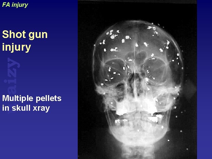 FA injury uraizy Shot gun injury Multiple pellets in skull xray 