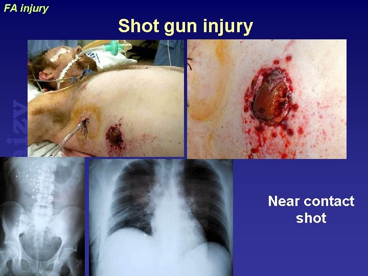 uraizy FA injury Shot gun injury Near contact shot 